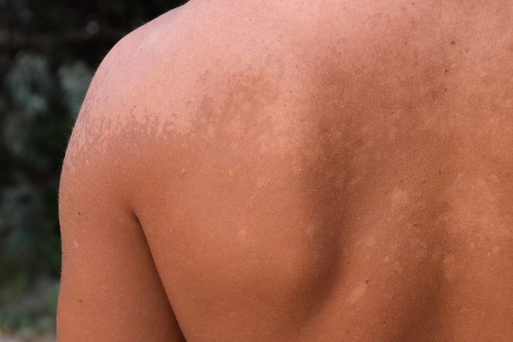 Smiling woman in white sweater happy after Canesten ringworm treatment