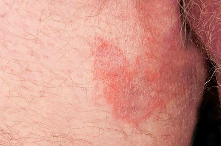 Nấm Bẹn: Nguyên Nhân, Triệu Chứng và Cách Điều Trị Hiệu Quả 8 Da bong tróc do nấm bẹn